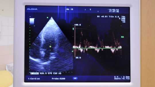 Ilustračná snímka-sonografia.
