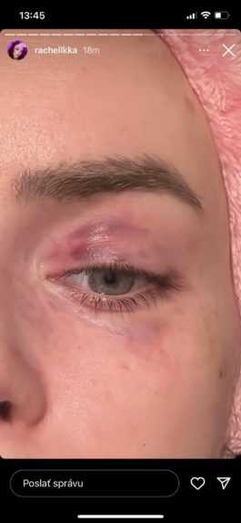 Bitka aj zničený byt. Na prípad napadnutej influencerky reaguje aj generálny prokurátor