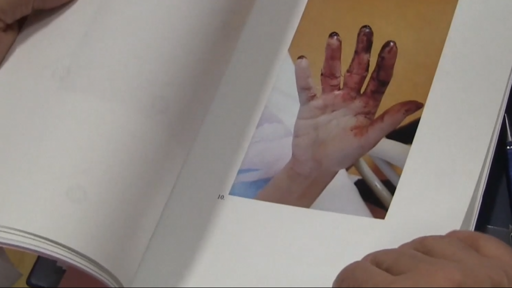 Znalec Jozef Krajčovič skúmal poranenia Judity.