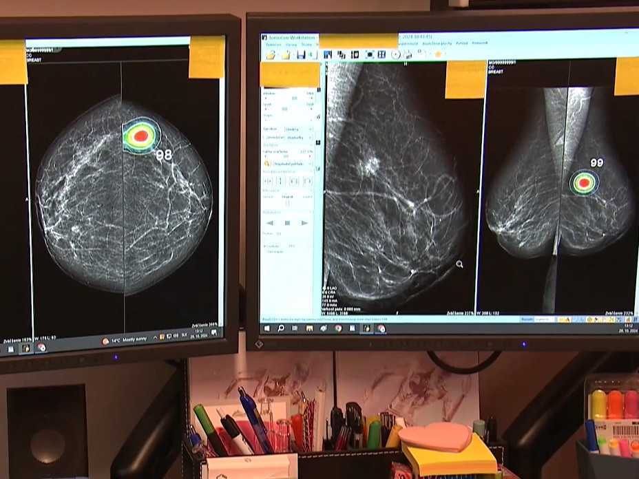 Röntgenový snímok prsníka.