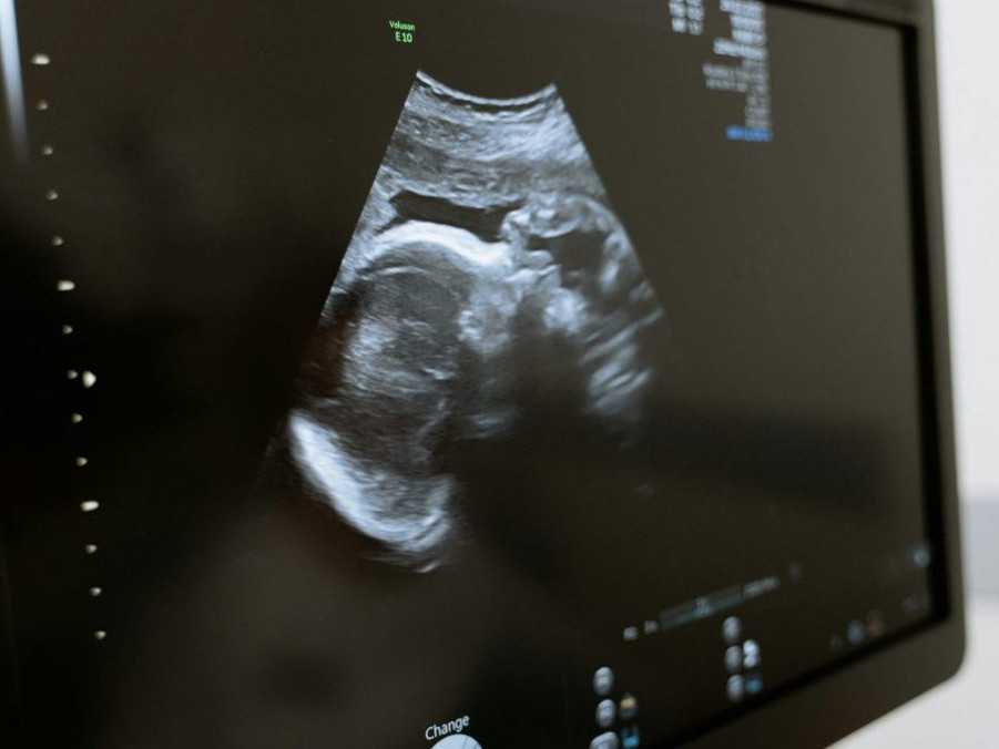 Na ilustračnej snímke ultrazvuk.