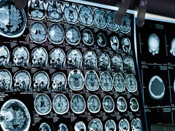 Na snímke je sken mozgu z centrálneho tomografu.