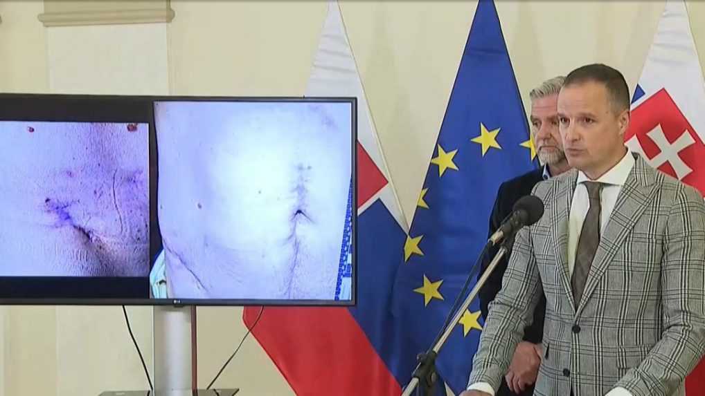 Advokát R. Fica zverejnil zábery zranení premiéra po atentáte v Handlovej