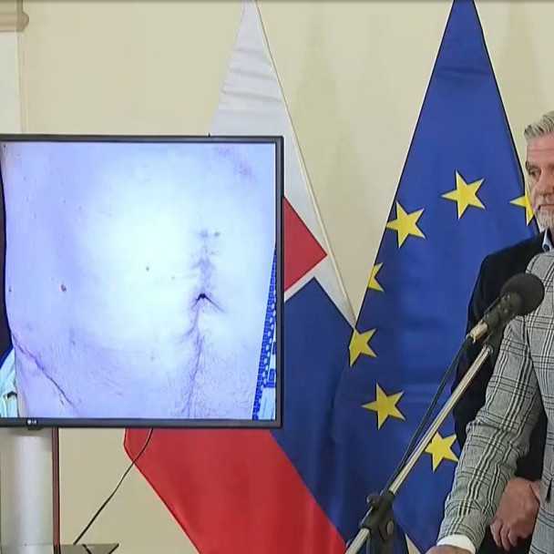 Advokát R. Fica zverejnil zábery zranení premiéra po atentáte v Handlovej