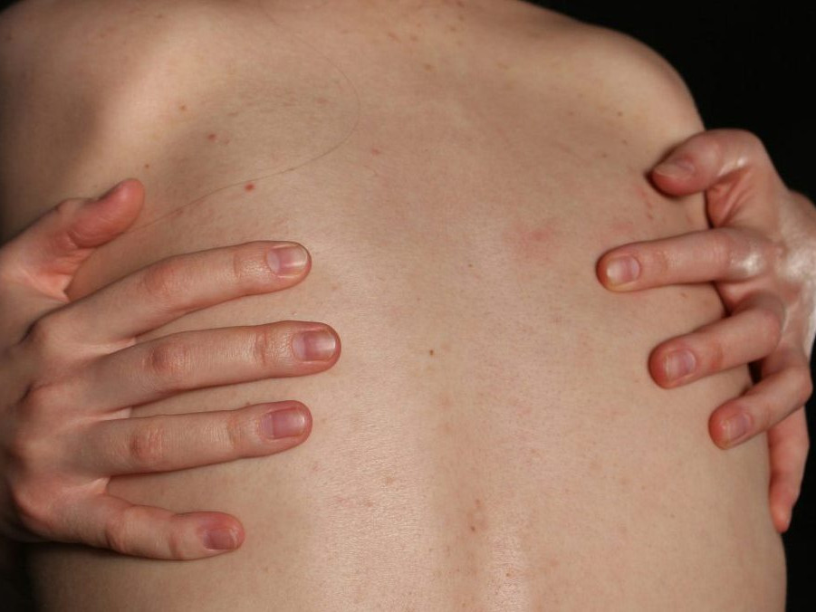 Na ilustračnej snímke ženský chrbát.