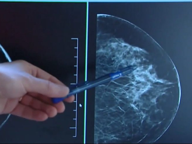 Na ilustračnej snímke mamografia prsníka.