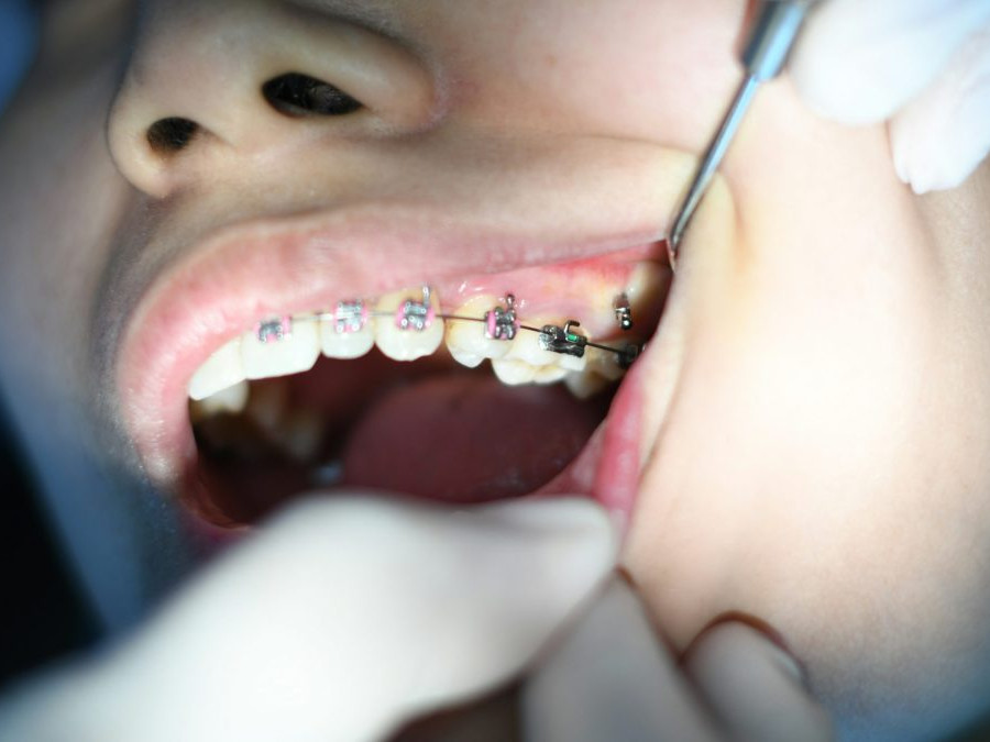 Na snímke je osoba so strojčekom pri návšteve zubára.