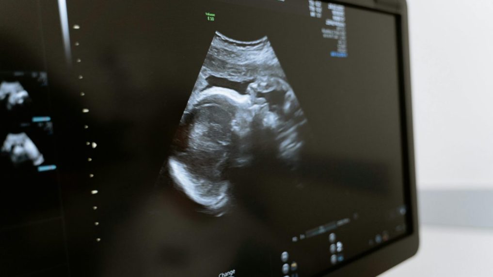 Na ilustračnej snímke ultrazvuk.