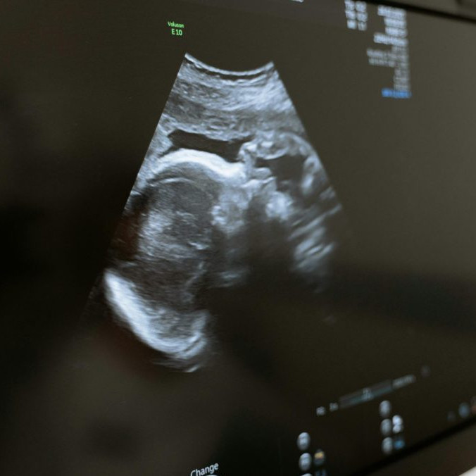 Na ilustračnej snímke ultrazvuk.