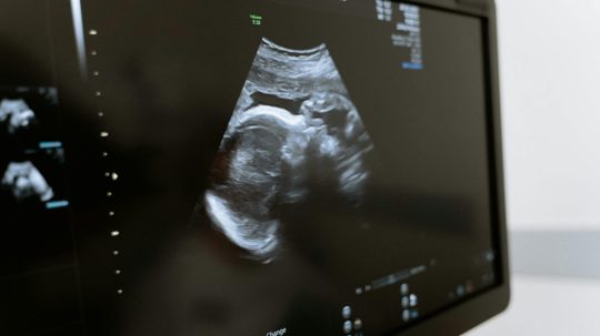 Na ilustračnej snímke ultrazvuk.