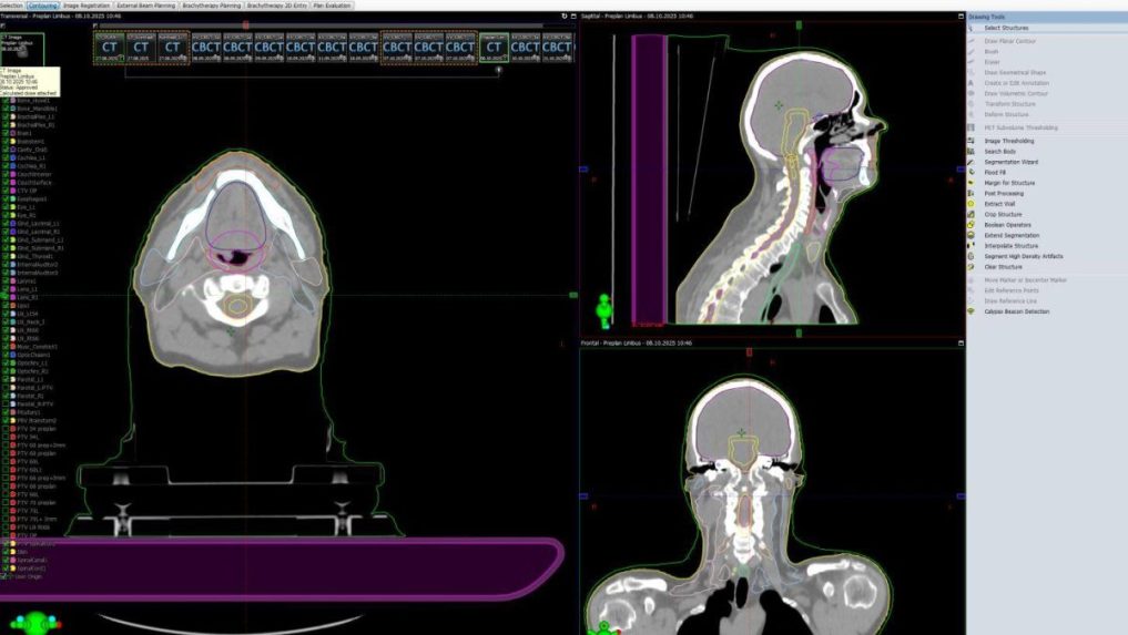 Rýchlejšia a presnejšia liečba: V ružomberskej nemocnici zaviedli umelú inteligenciu pri plánovaní rádioterapie