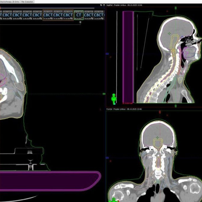 Rýchlejšia a presnejšia liečba: V ružomberskej nemocnici zaviedli umelú inteligenciu pri plánovaní rádioterapie