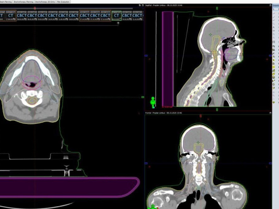Rýchlejšia a presnejšia liečba: V ružomberskej nemocnici zaviedli umelú inteligenciu pri plánovaní rádioterapie