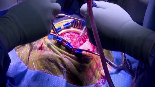 Umelé orgány počas simulovanej operácie.