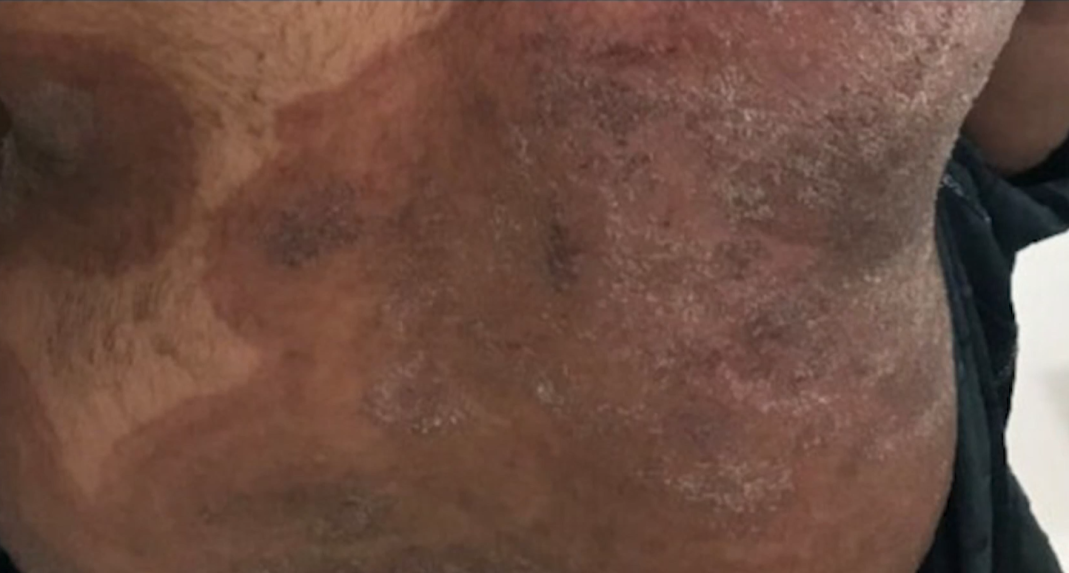 Na snímke pacient so superplesňou.