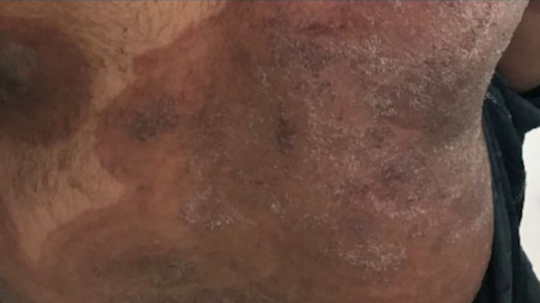 Na snímke pacient so superplesňou.